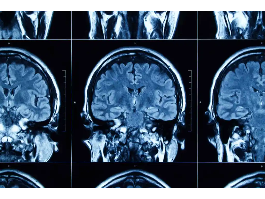 Scientist Find Treatment that Lower Brain Inflammation - TBI | Louisville | Call (502) 771-1529