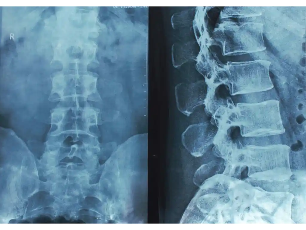 Spinal Cord Injury with Tetraplegia in Youngs | Louisville | T: (502) 771-1529