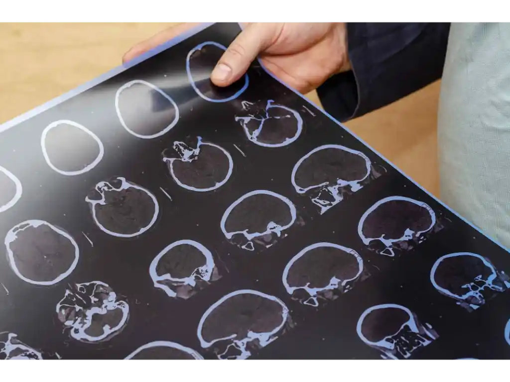 Cerebral Microbleeds After TBI | Louisville, KY | Call (502) 771-1529